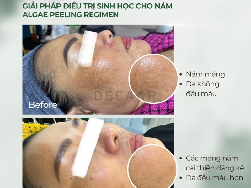 cách điều trị nám mảng